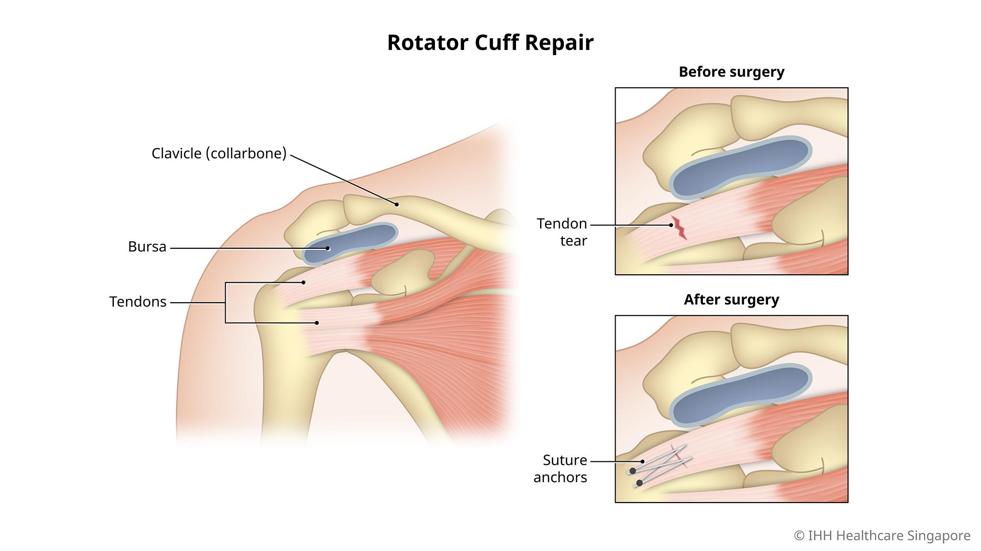 A shoulder rotator cuff repair is a surgery to repair torn muscles at the shoulder joint.