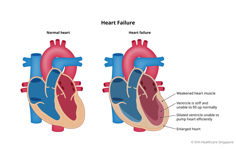 Heart-Failure-9-01