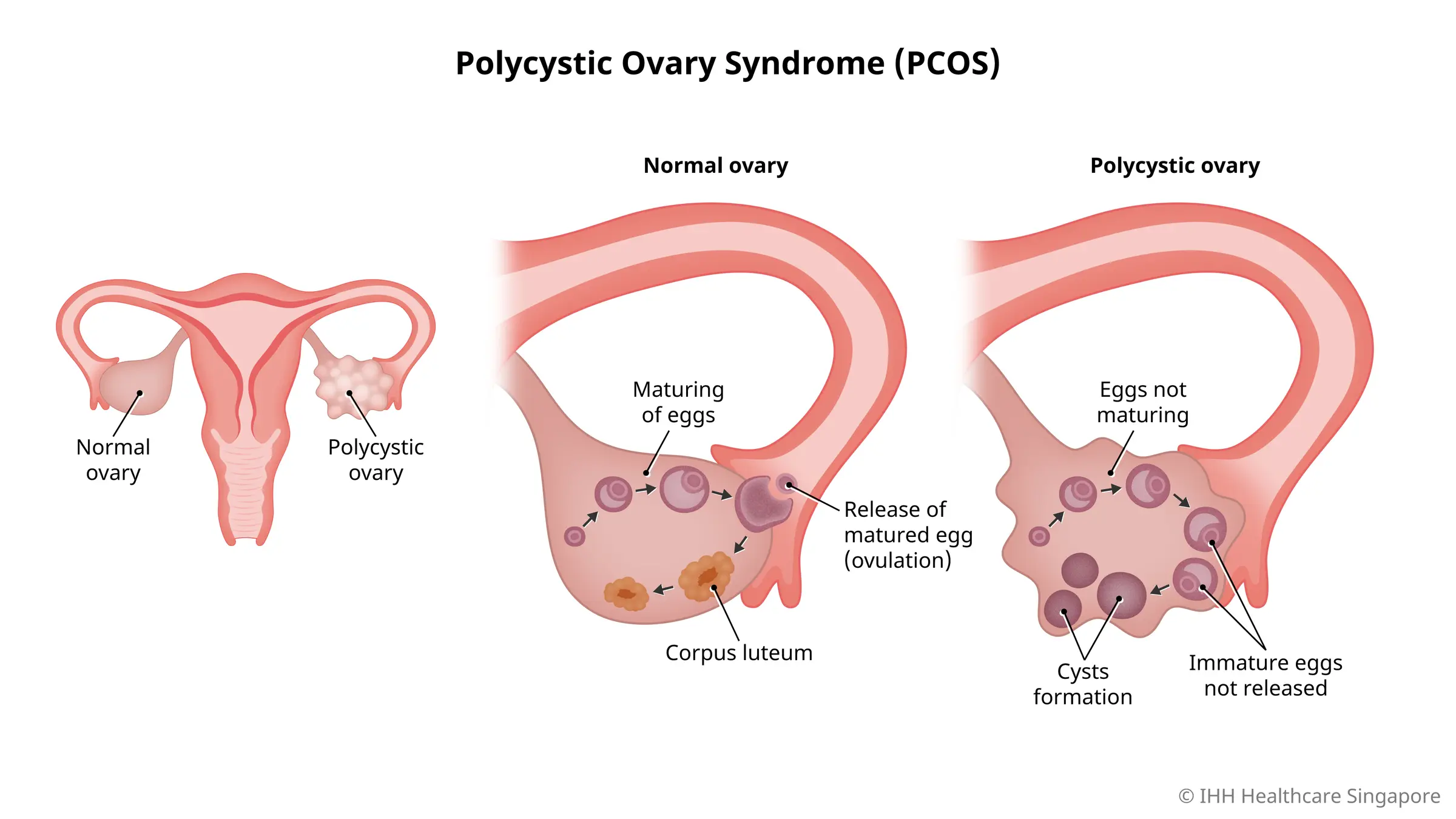 Polycystic Ovary Syndrome or PCOS is a common hormonal disorder that causes small cysts to form in women's ovaries.