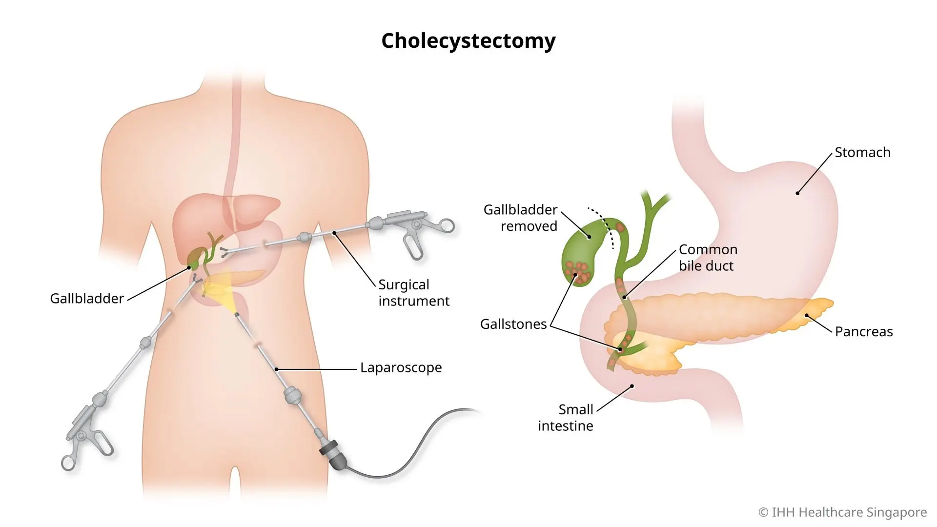 Illustration of gallbladder removal (cholecystectomy) surgery.