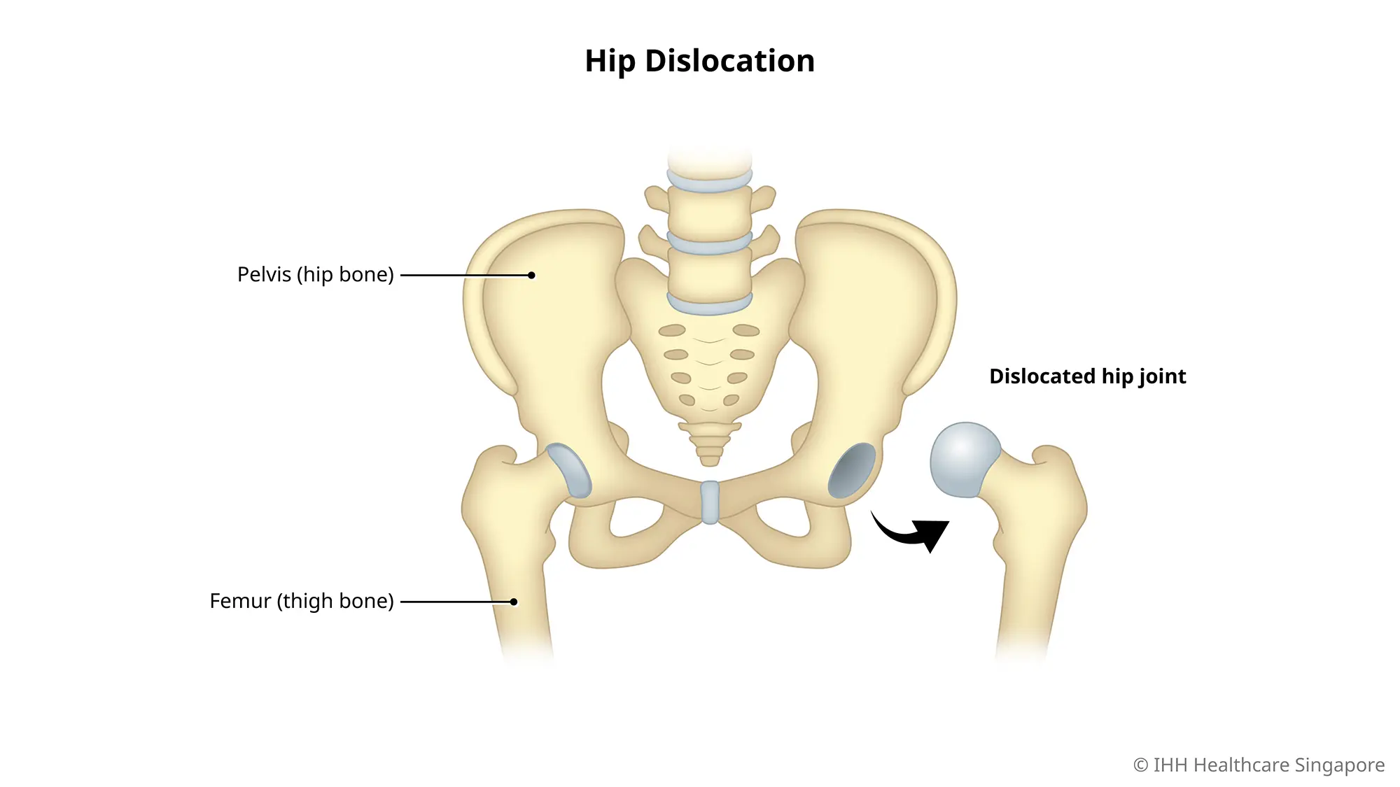 Hip dislocation