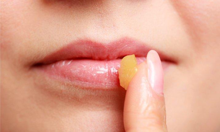 Medical treatments for dry lips