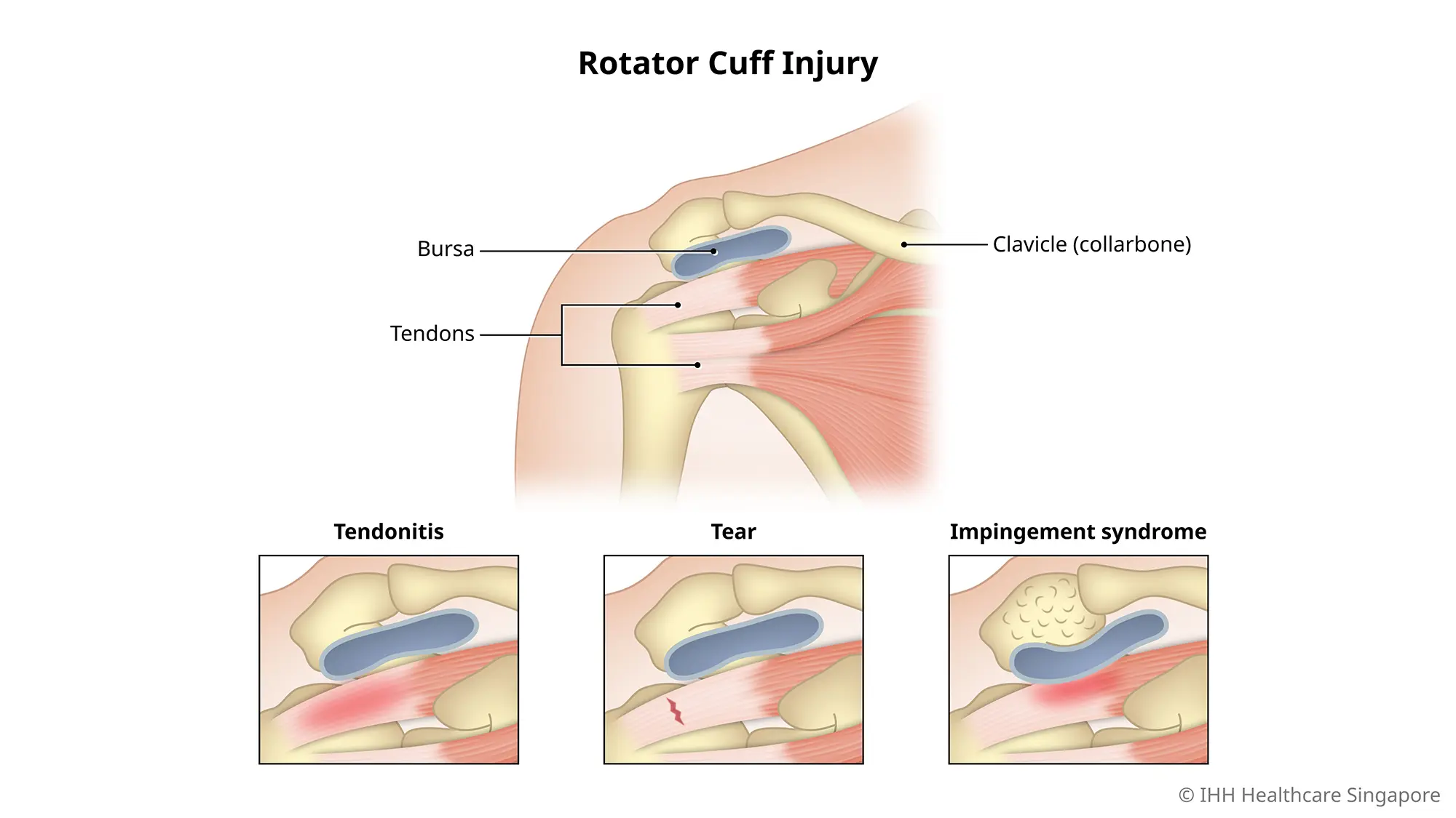 Rotator cuff injury is the inflammation and swelling of muscles and tendons at the shoulder joint.