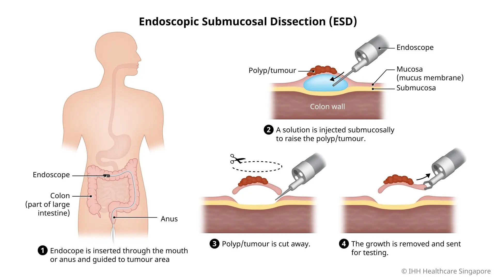 Illustration of the steps in an endoscopic submucosal dissection (ESD).