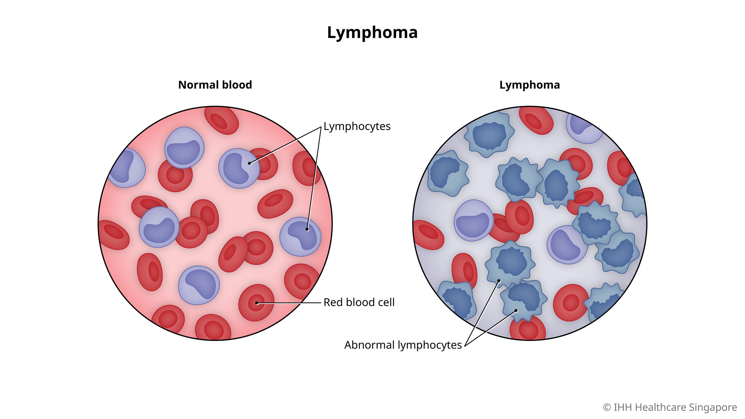 Nursing Paper Example on Lymphoma [SOLVED]