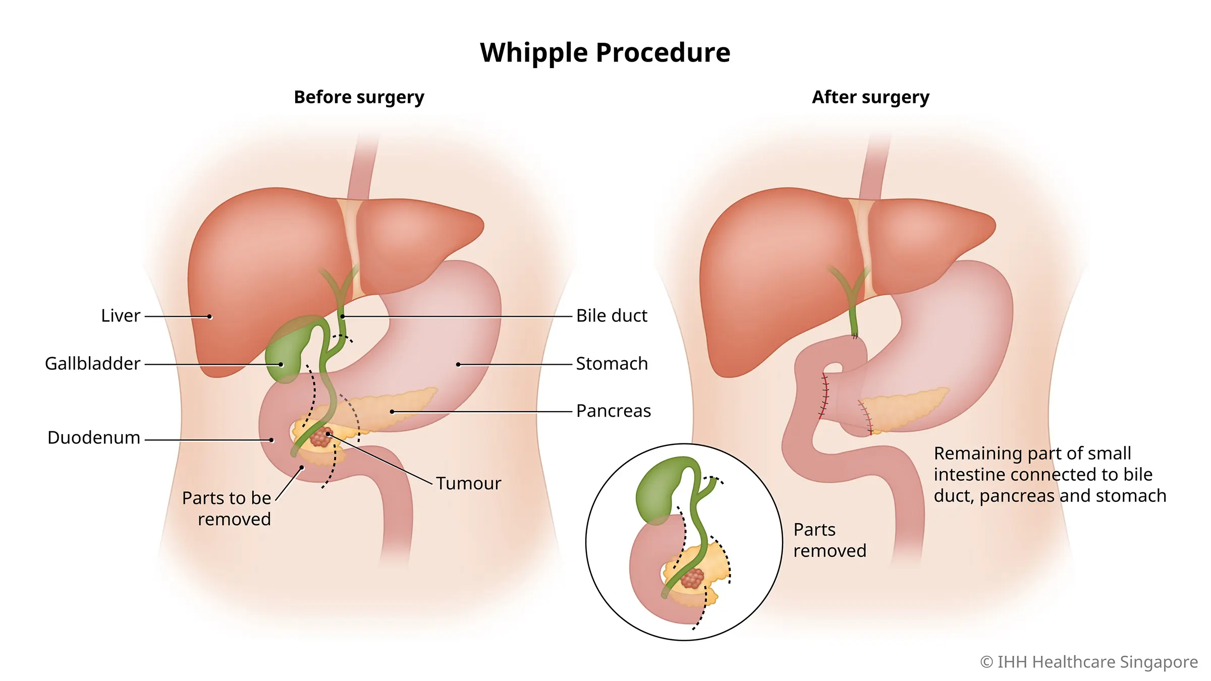 Whipple procedure