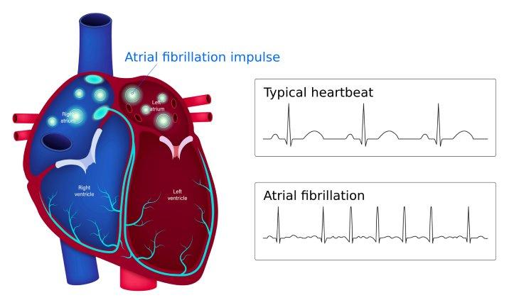 Atrial fibrillation illustration