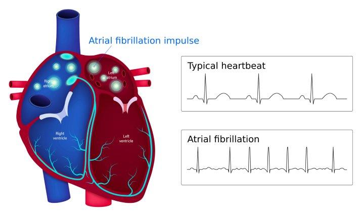 Ilustrasi fibrilasi atrium