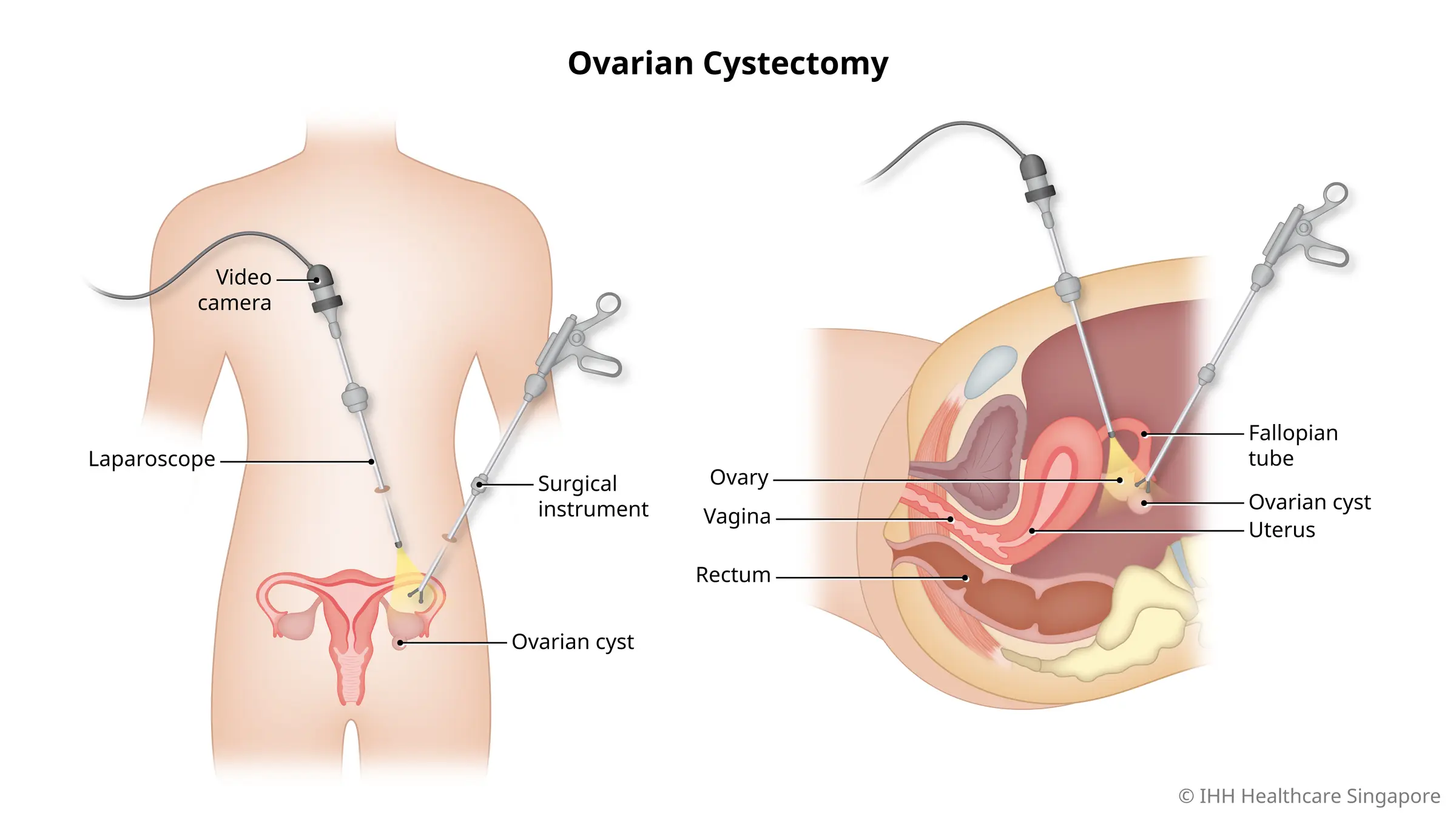 Ovarian Cysts Removal using Laparoscopy