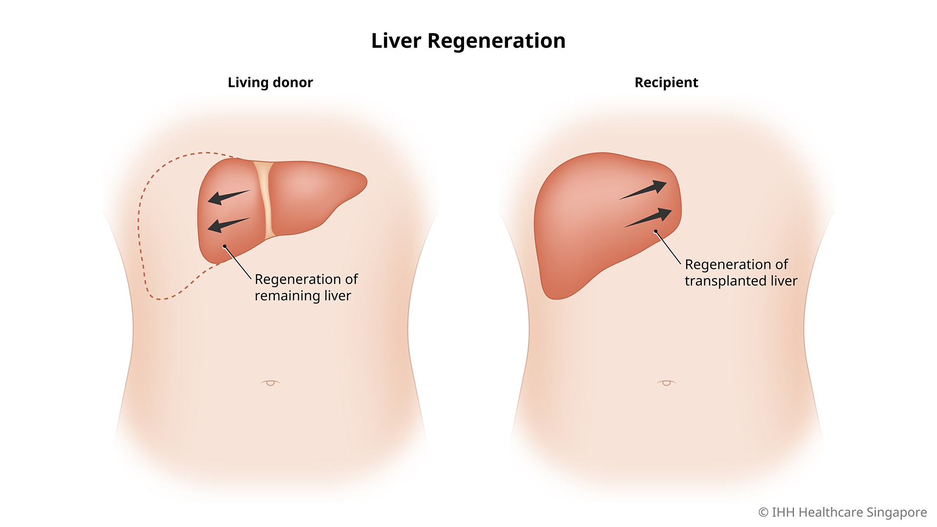 Liver Regeneration 201