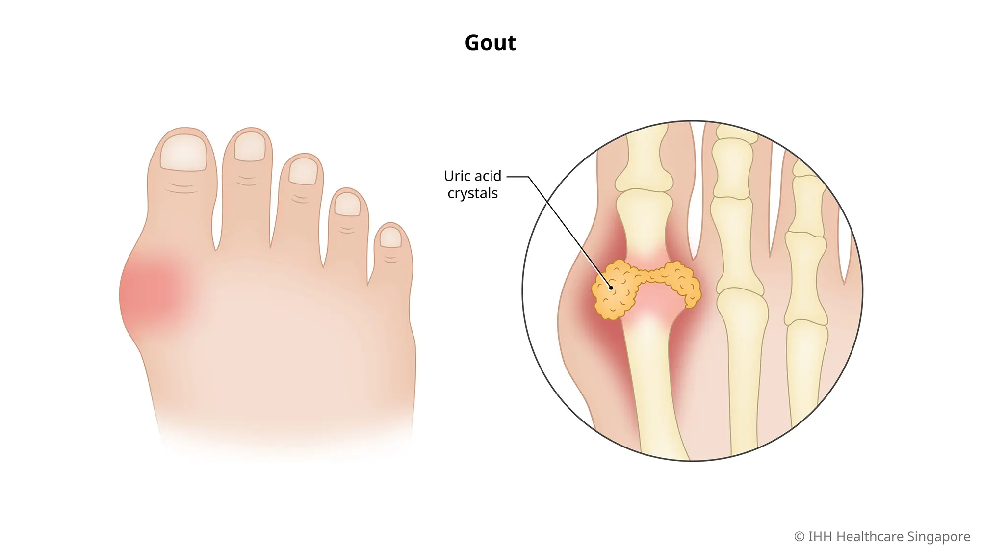 Uric acid accumulating in a joint