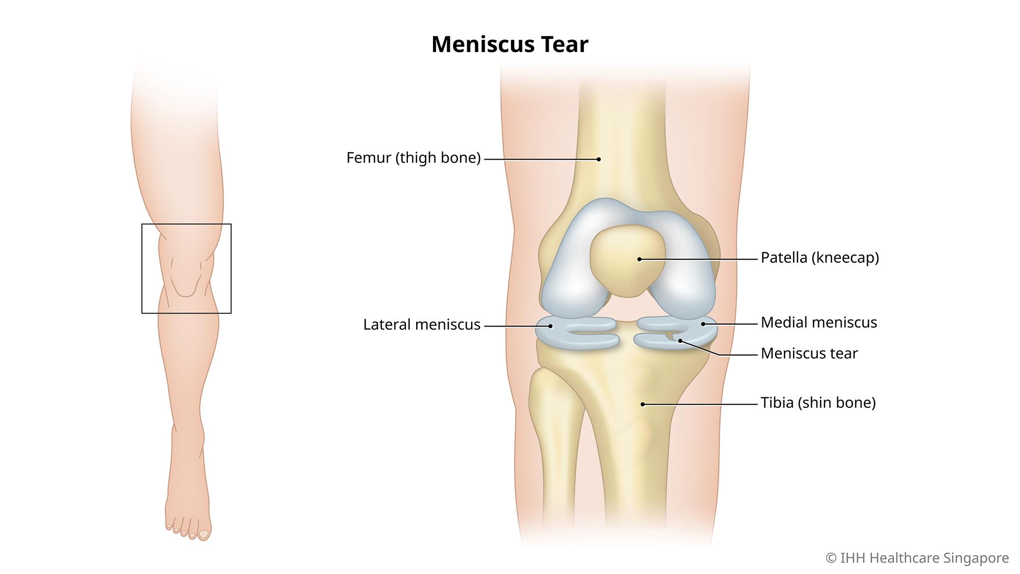 A meniscus tear occurs when one of the pieces of cartilage in the knee is injured and tears.