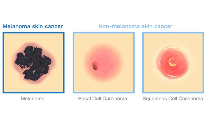 皮肤癌的类型