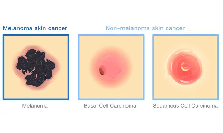 difference between melanoma and non melanoma