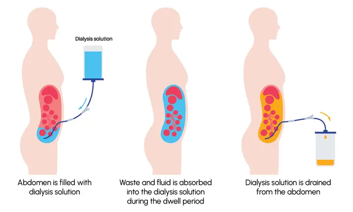 Bagaimana cara kerja dialisis peritoneal?