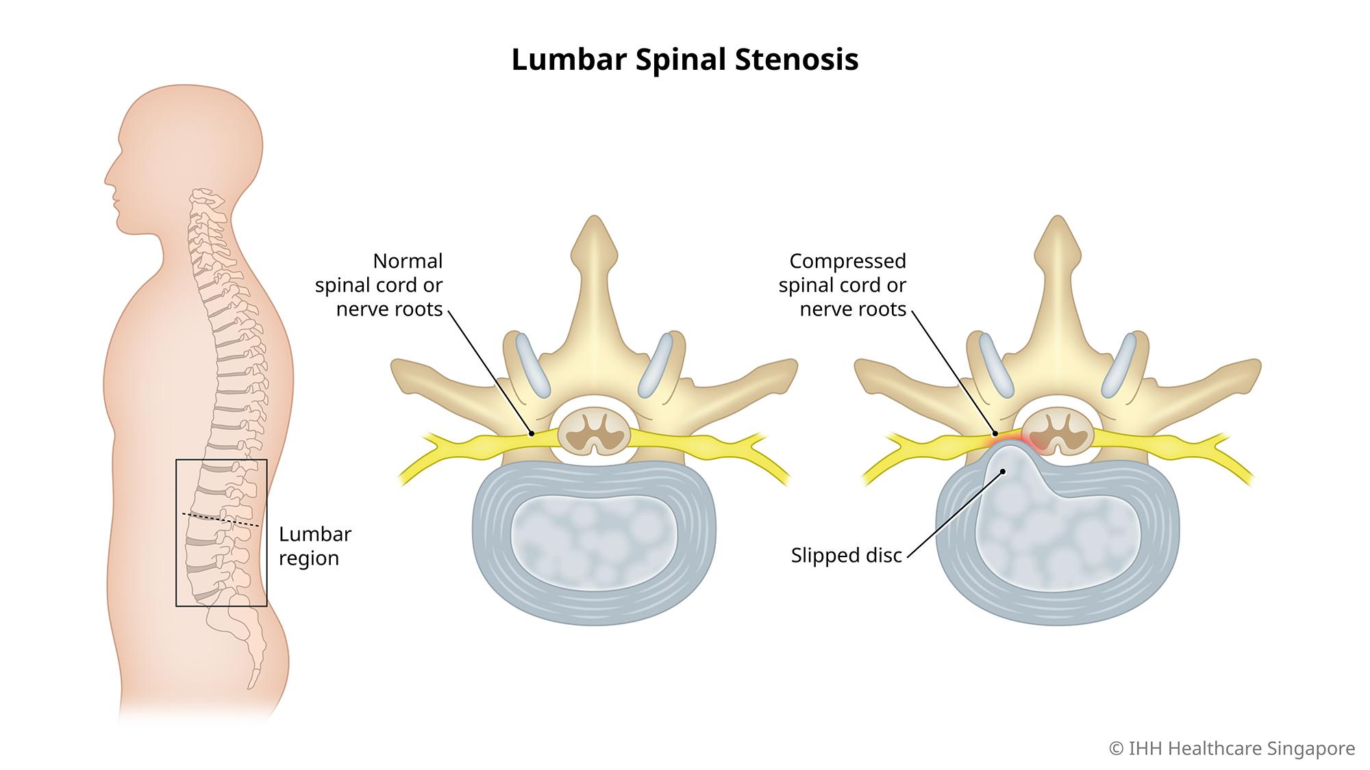 Lumbar spinal stenosis occurs when the space around the spinal cord narrows, causing back pain