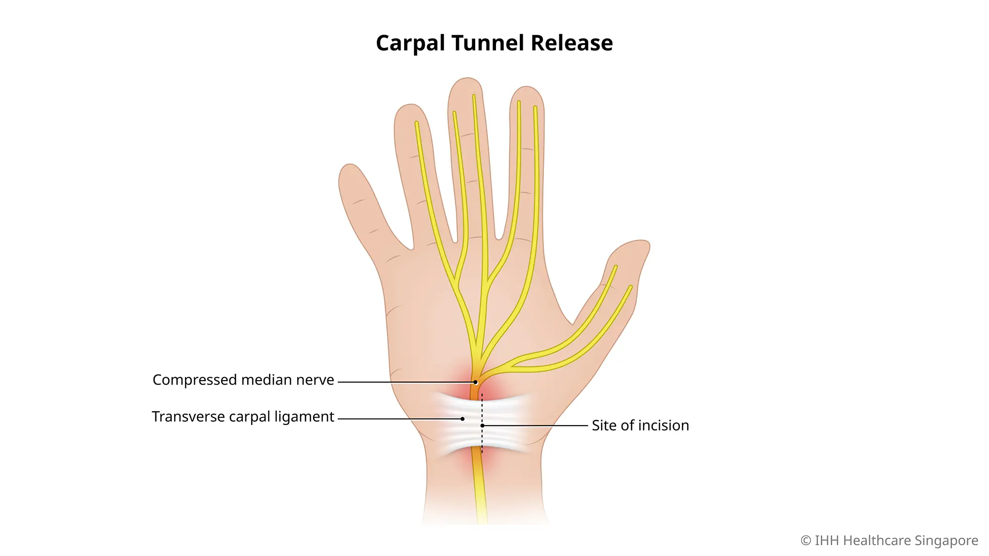 Carpal tunnel release surgery cuts the carpal ligament to reduce pressure on the median nerve