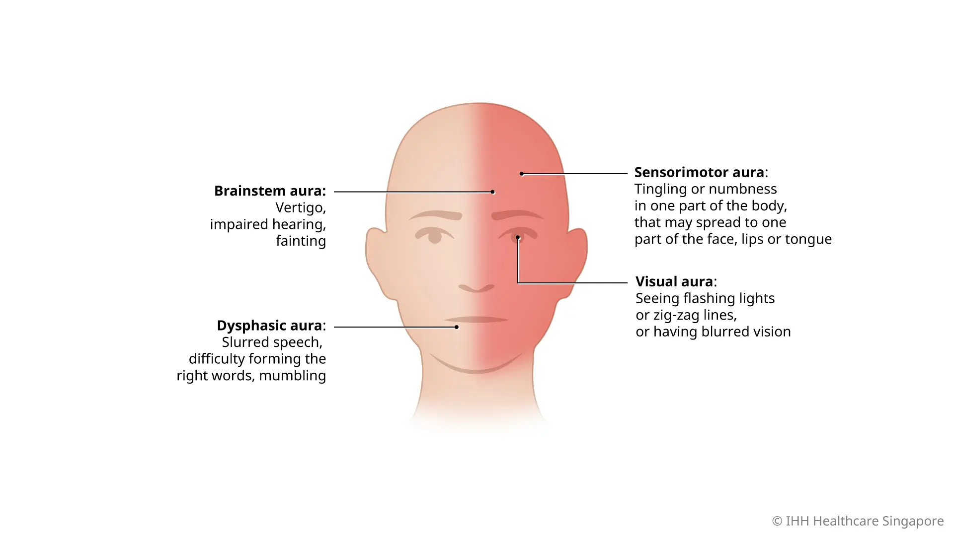 Migraines with aura