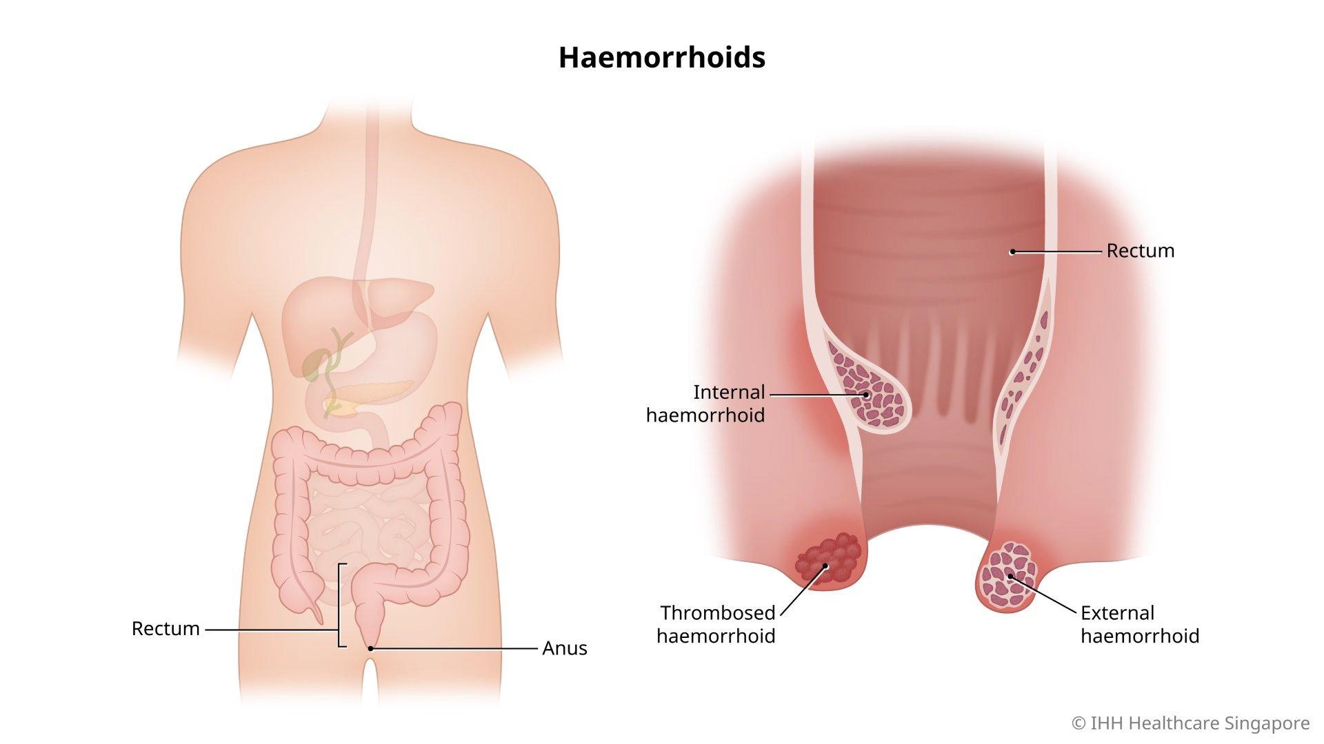 Illustration of the types of haemorrhoids, which include internal, thrombosed, and external.