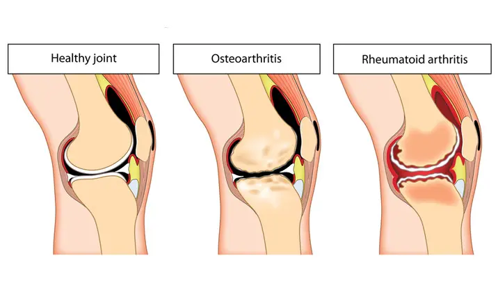 Knee Osteoarthritis, Knee, Health