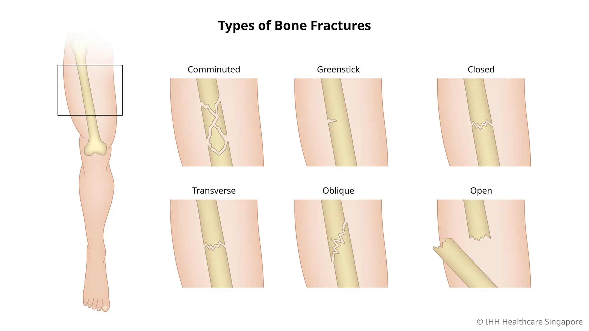 Hình minh họa các loại gãy xương khác nhau.