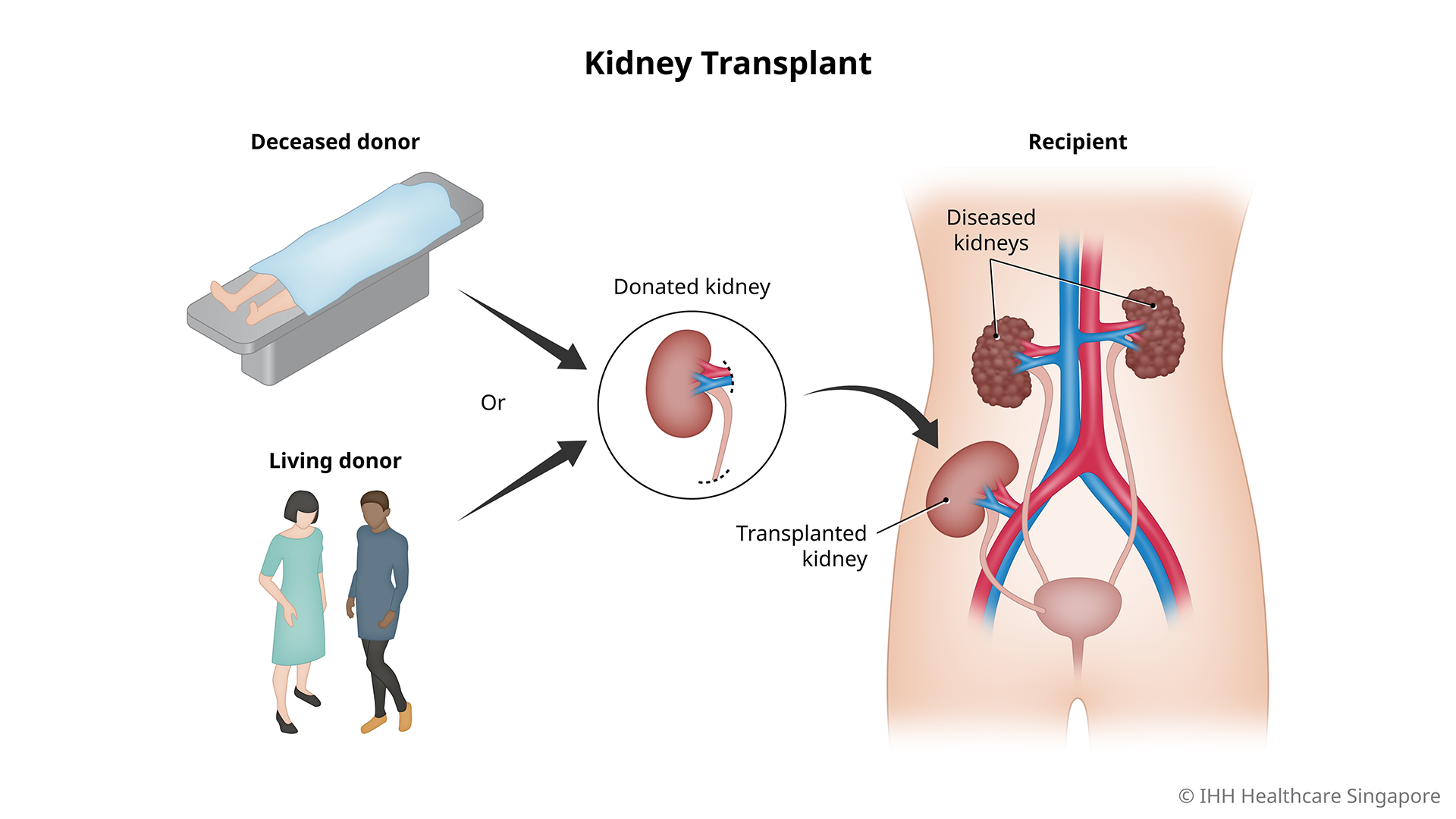 Kidney Transplant 3 01