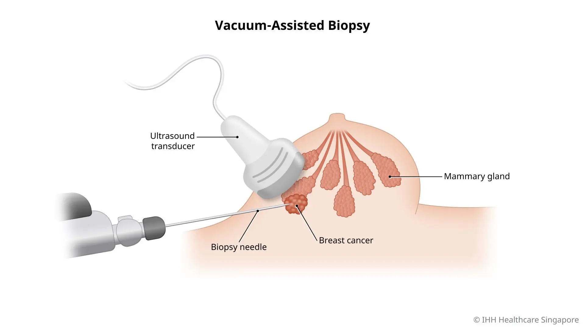 Illustration of a vacuum-assisted biopsy (VAB).