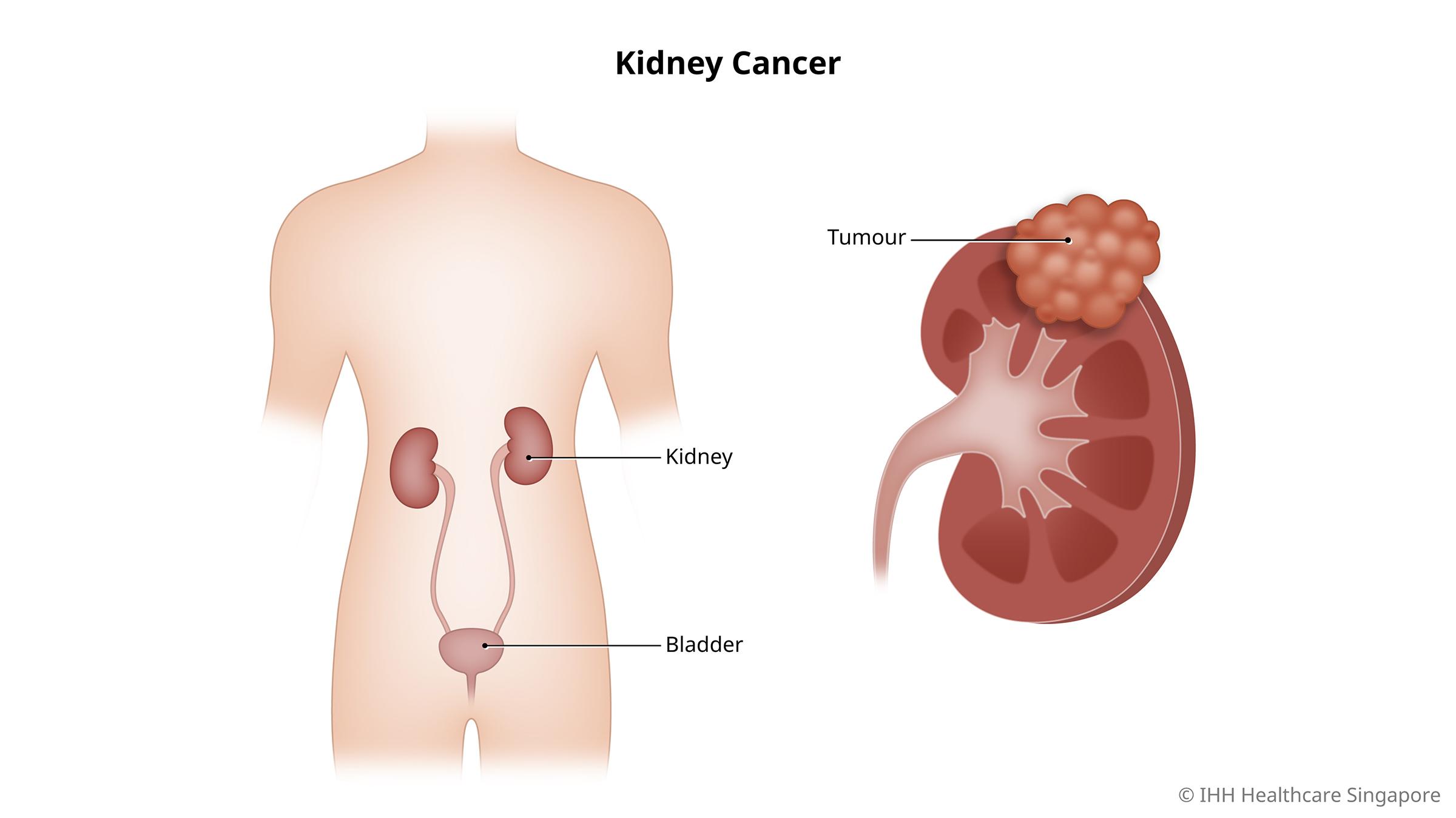 kidney cancer stages