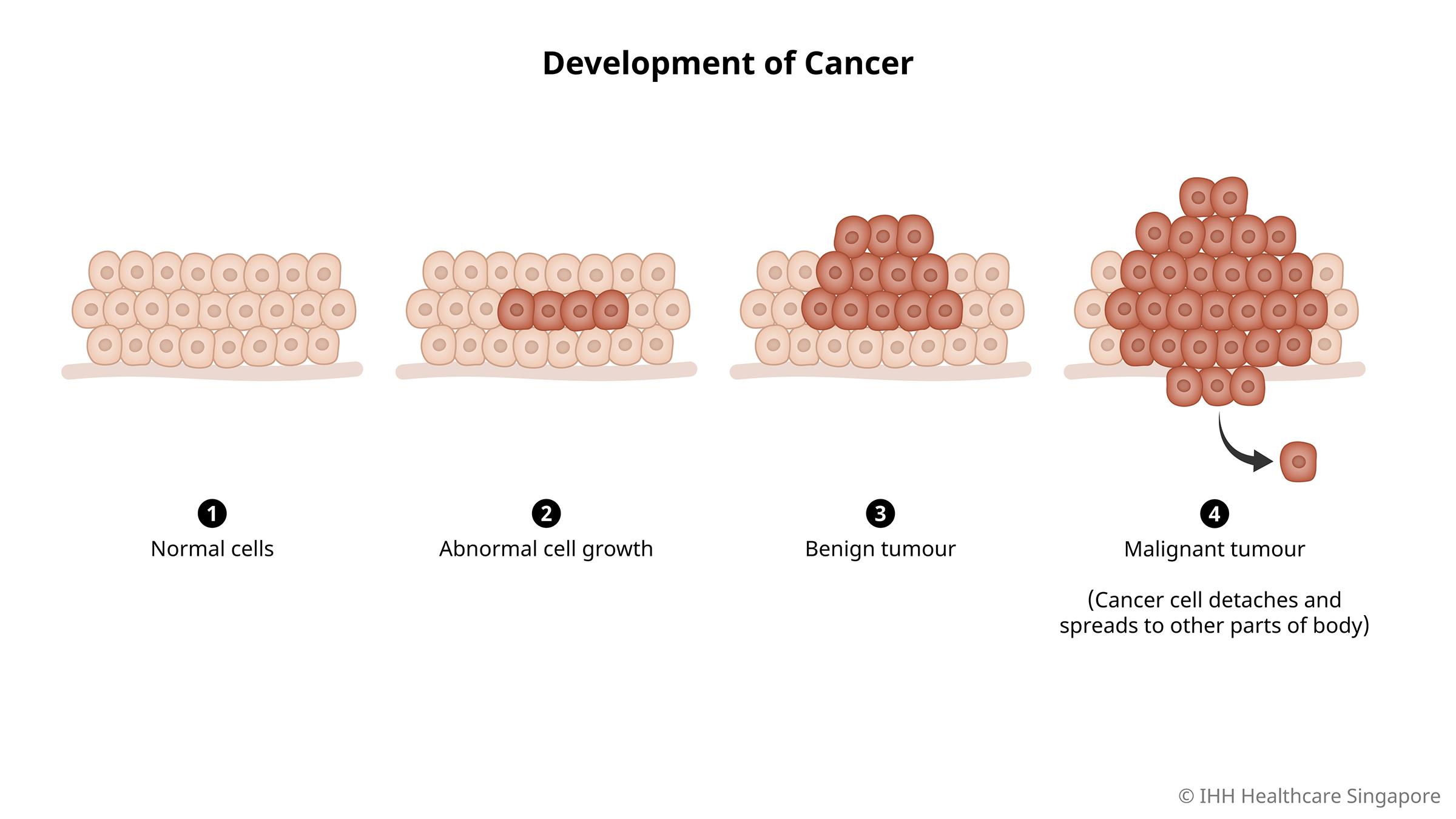 Quá trình phát triển ung thư