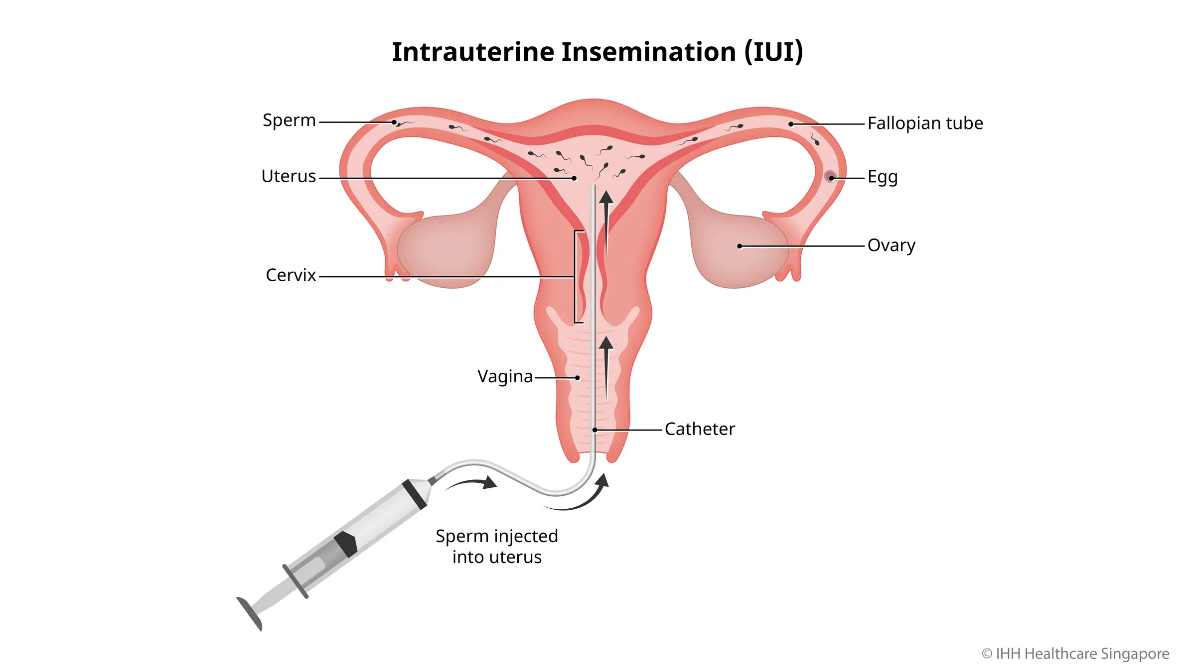 Điều gì sẽ xảy ra khi bơm tinh trùng vào buồng tử cung (IUI)?