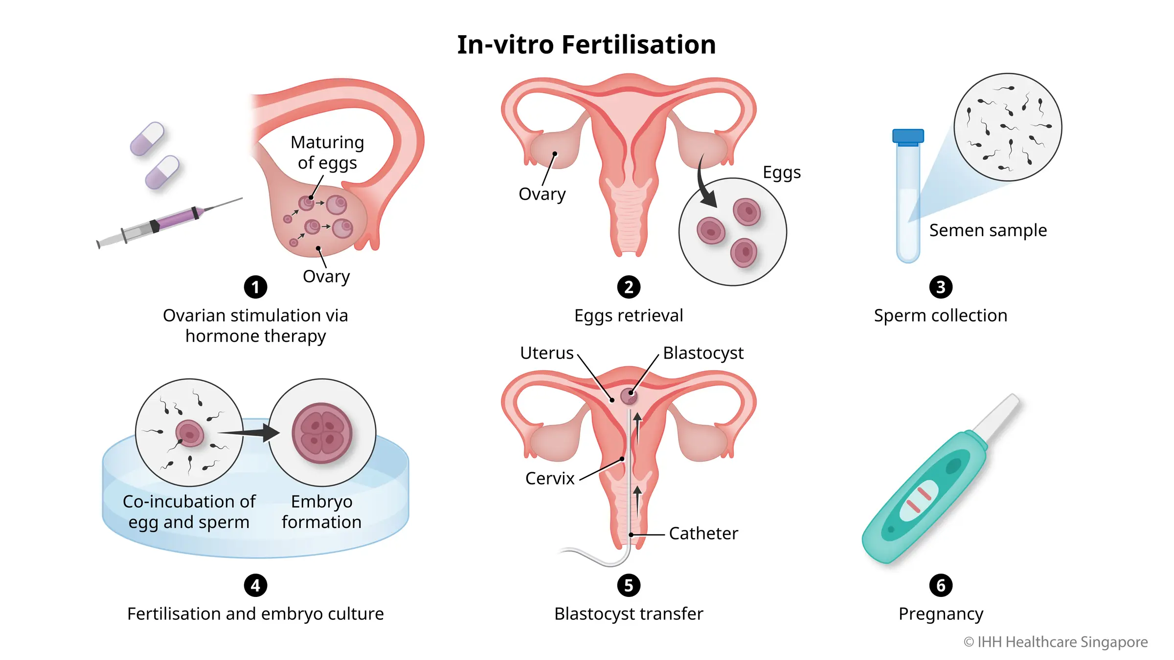 Điều gì sẽ xảy ra khi thụ tinh trong ống nghiệm (IVF)?
