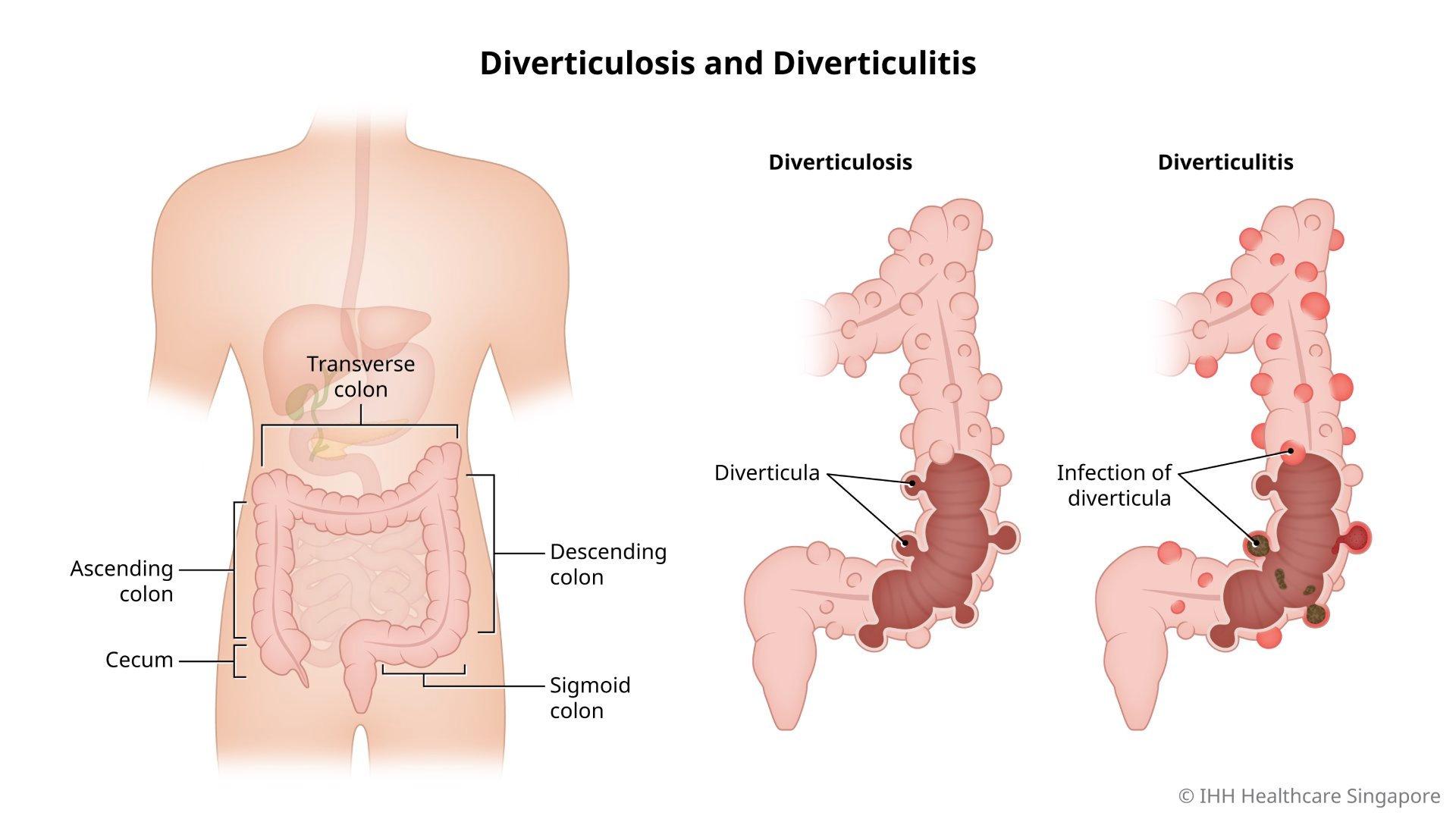 Illustration of the differences between diverticulosis and diverticulitis.