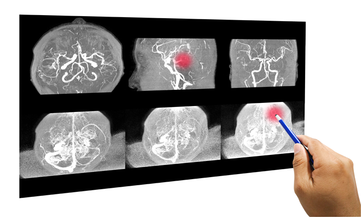 Reina Aneurysm Article_In Text Image_Angiography_6 May