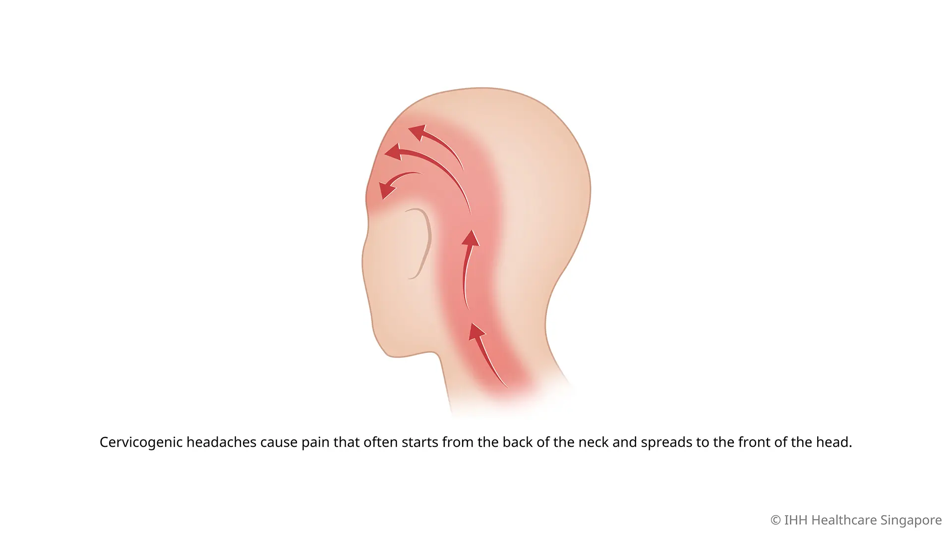 What is a cervicogenic headache