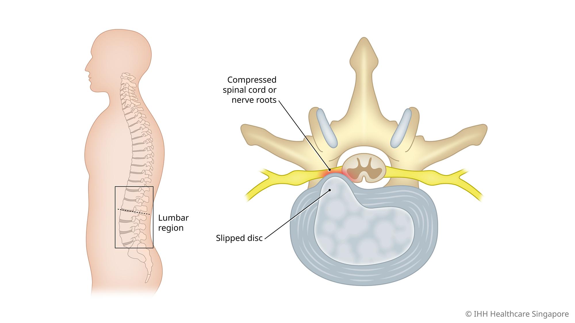 What causes sciatica