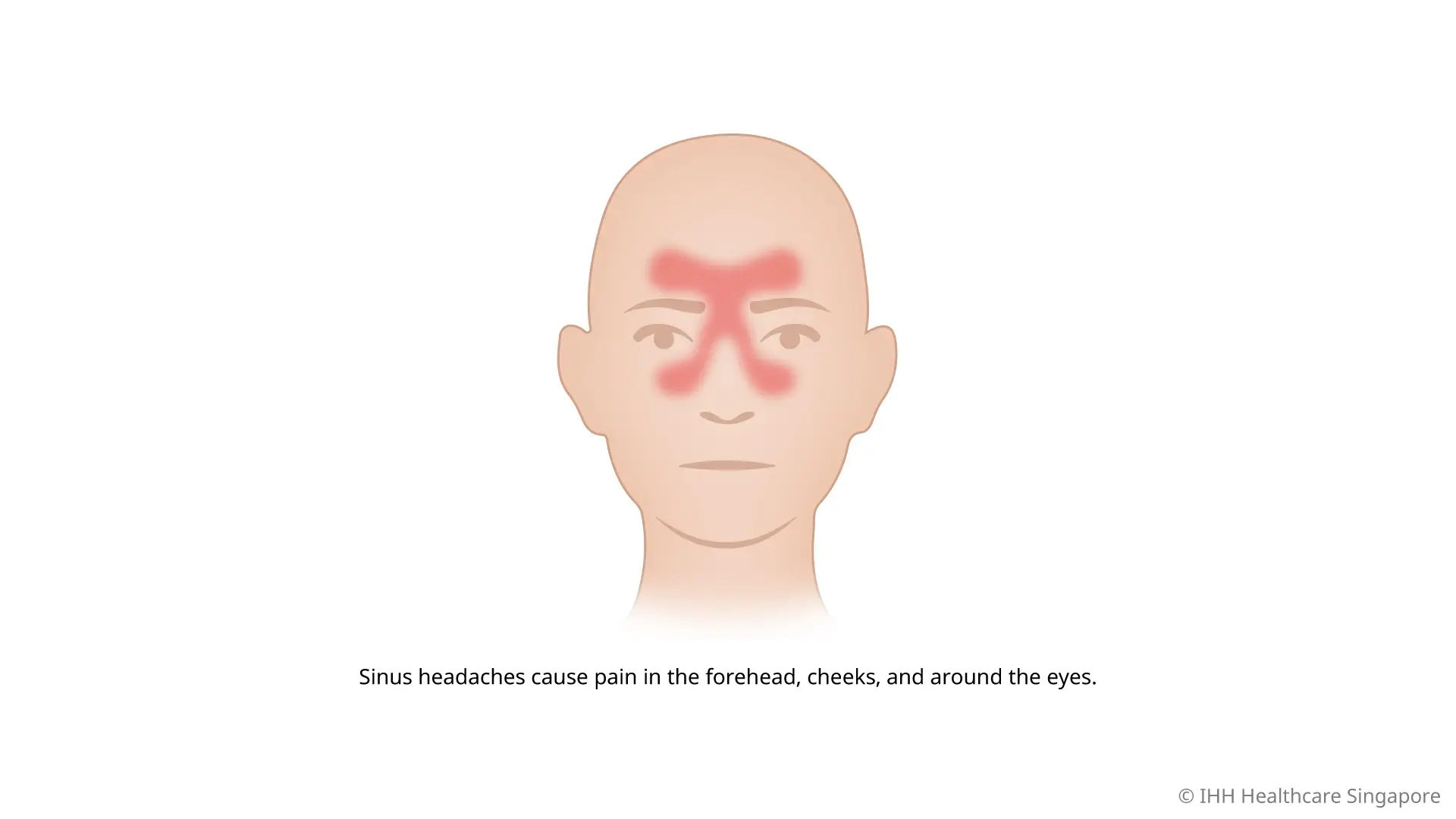 What is a sinus headache