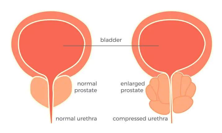 Benign Prostate Hyperplasia (BPH)