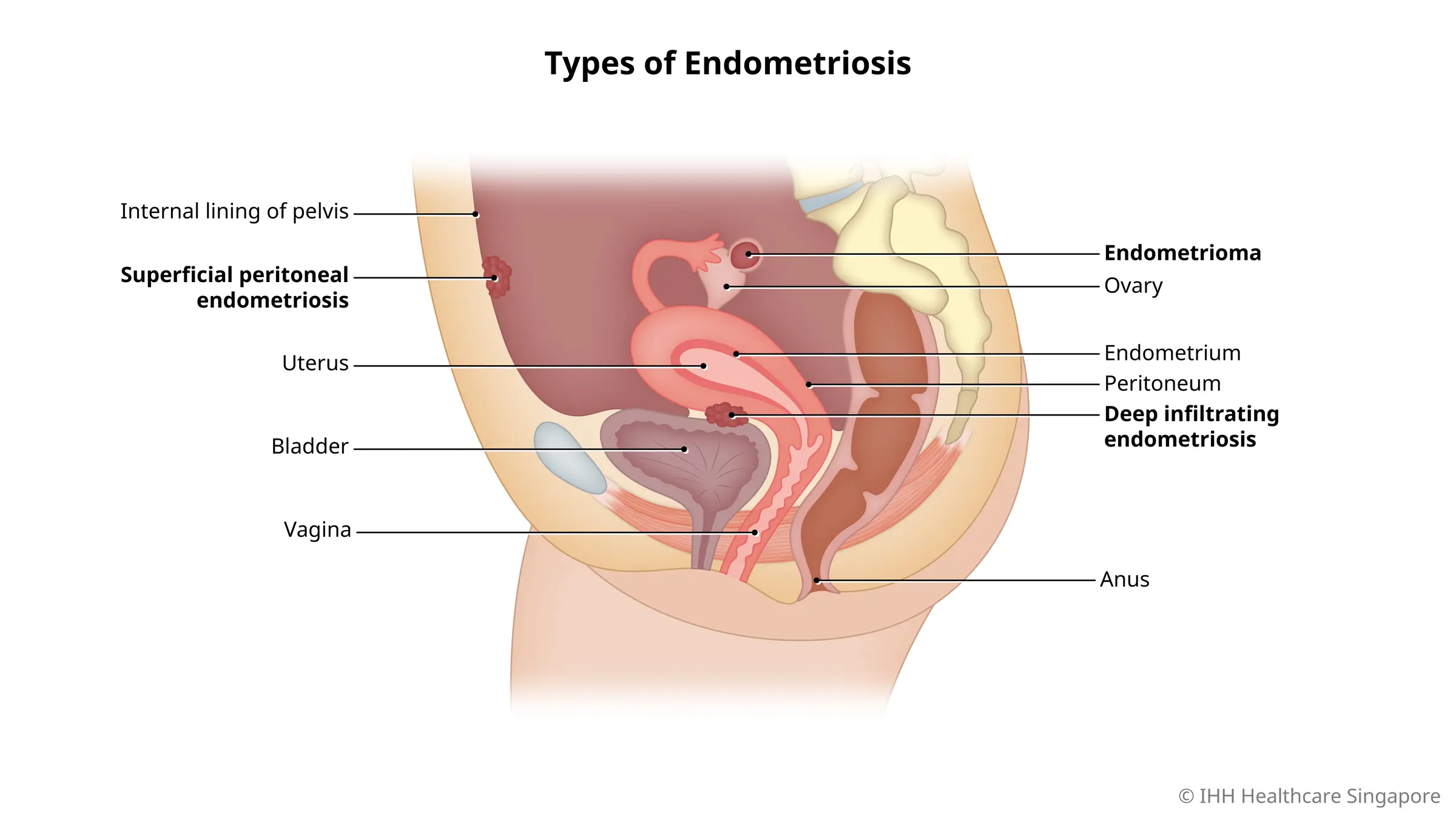 Endometriosis Symptoms & Pain » Signs of Endometriosis — A/Prof