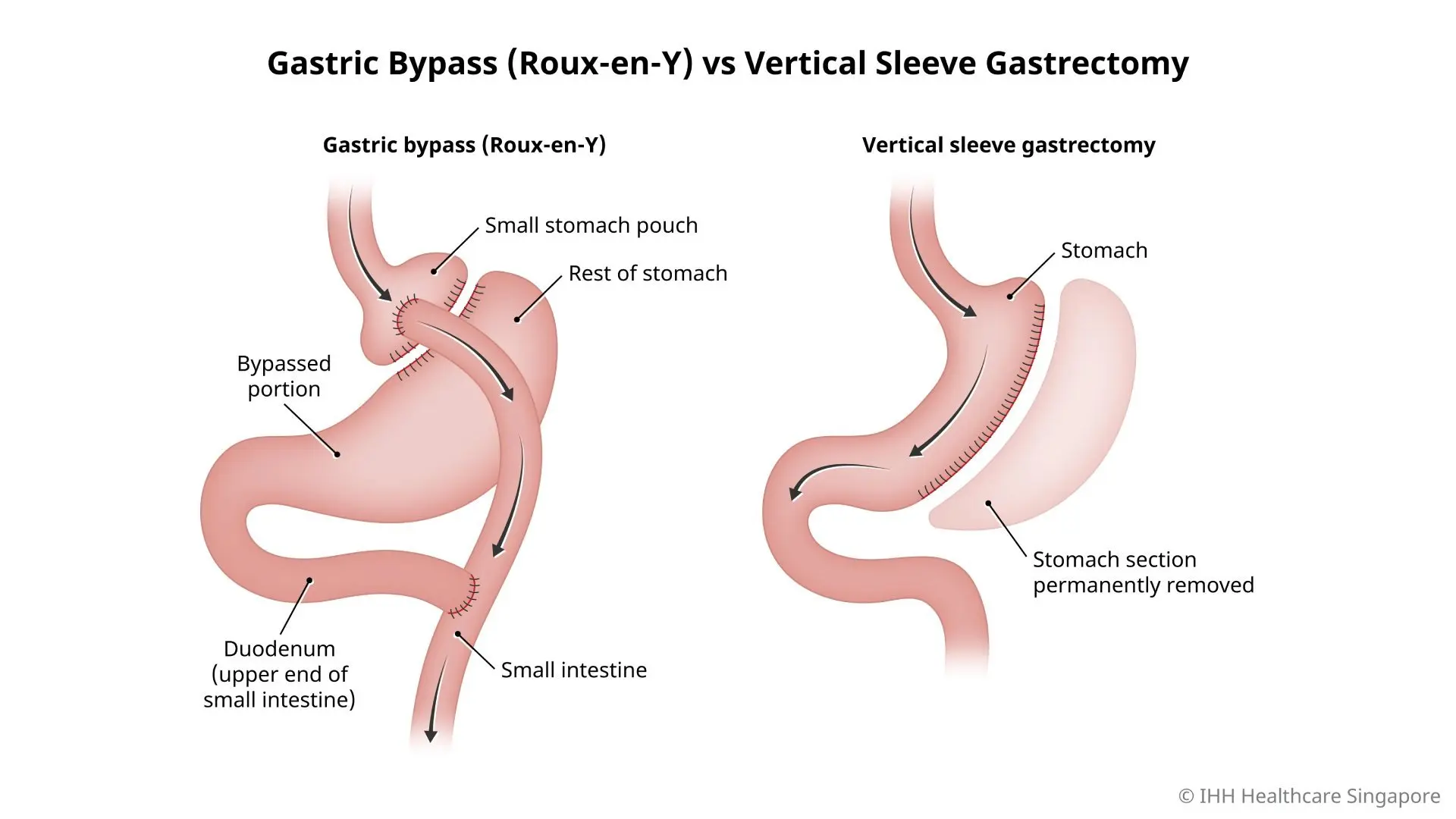 Illustration of the differences between gastric bypass (Roux-en-Y) surgery and vertical sleeve gastrectomy surgery.