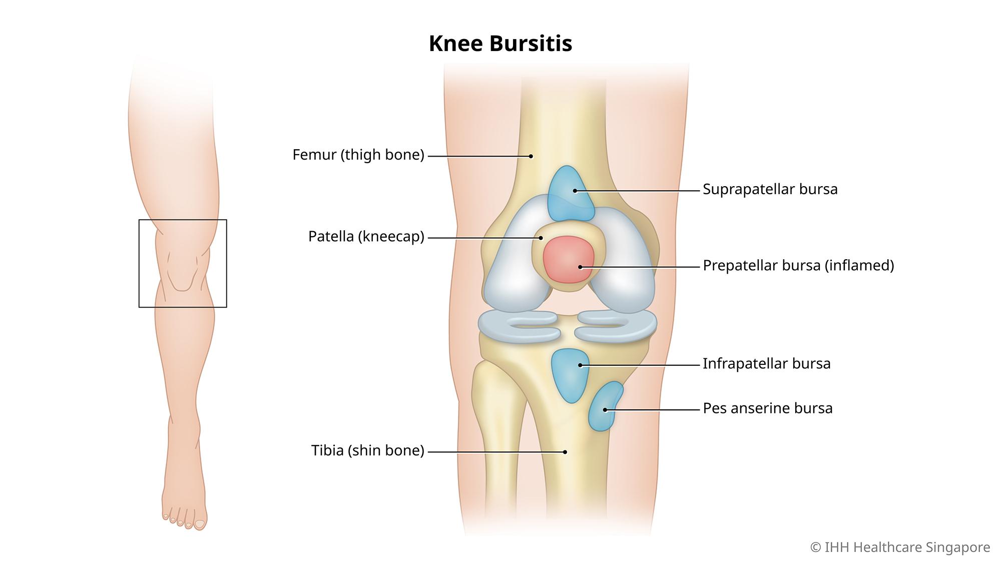 Bursitis lutut
