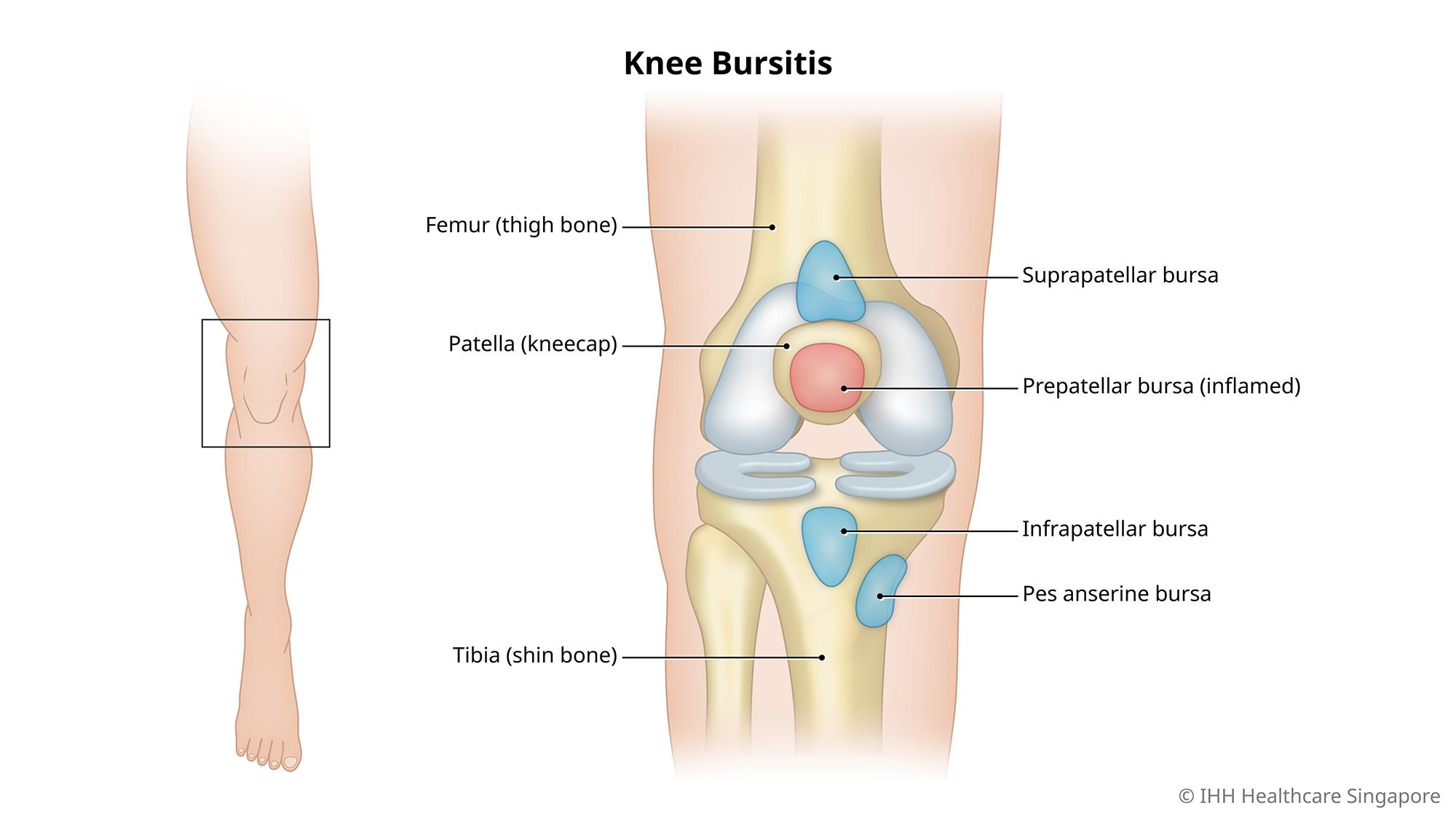 Knee bursitis