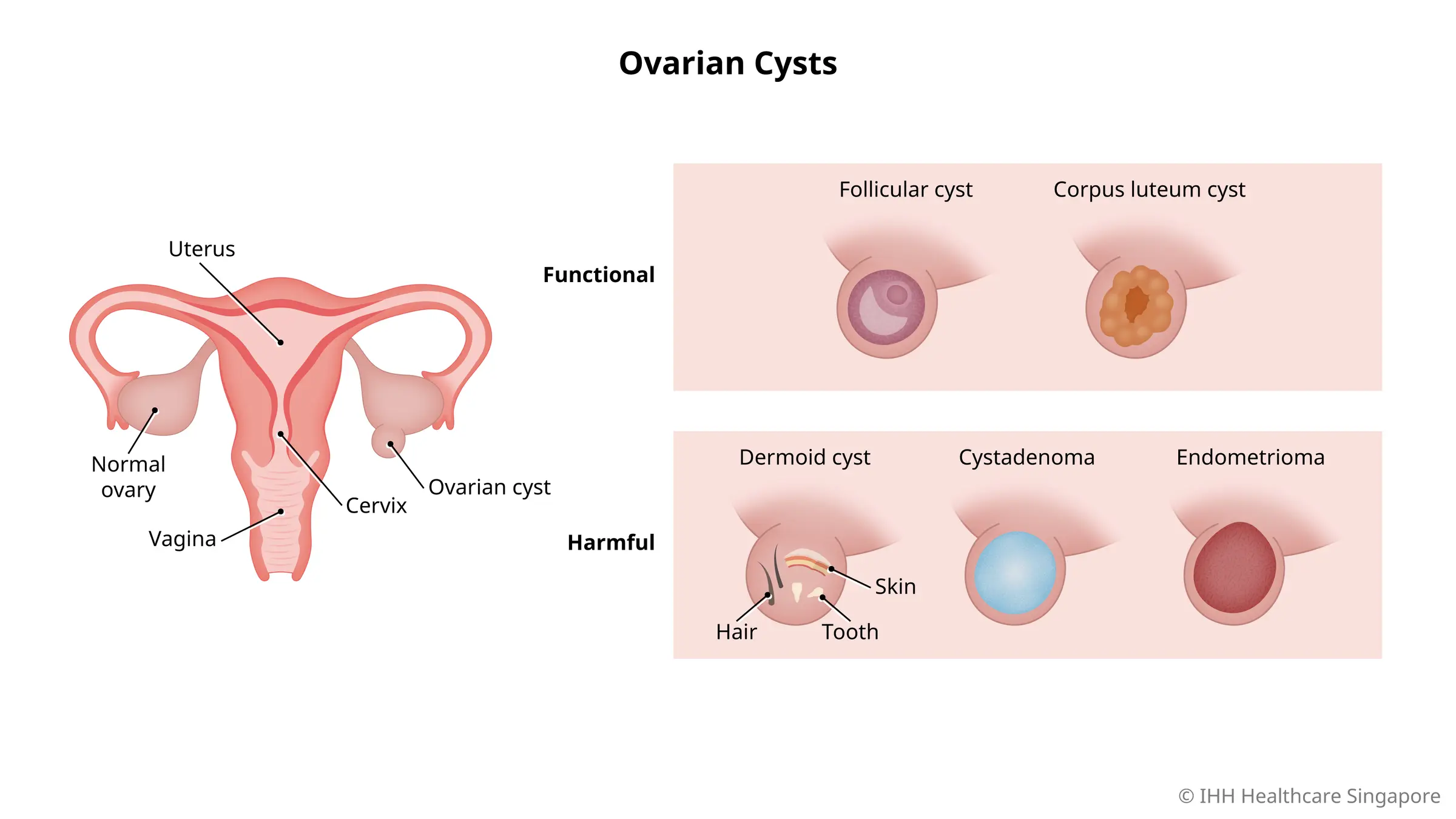Apa itu kista ovarium?