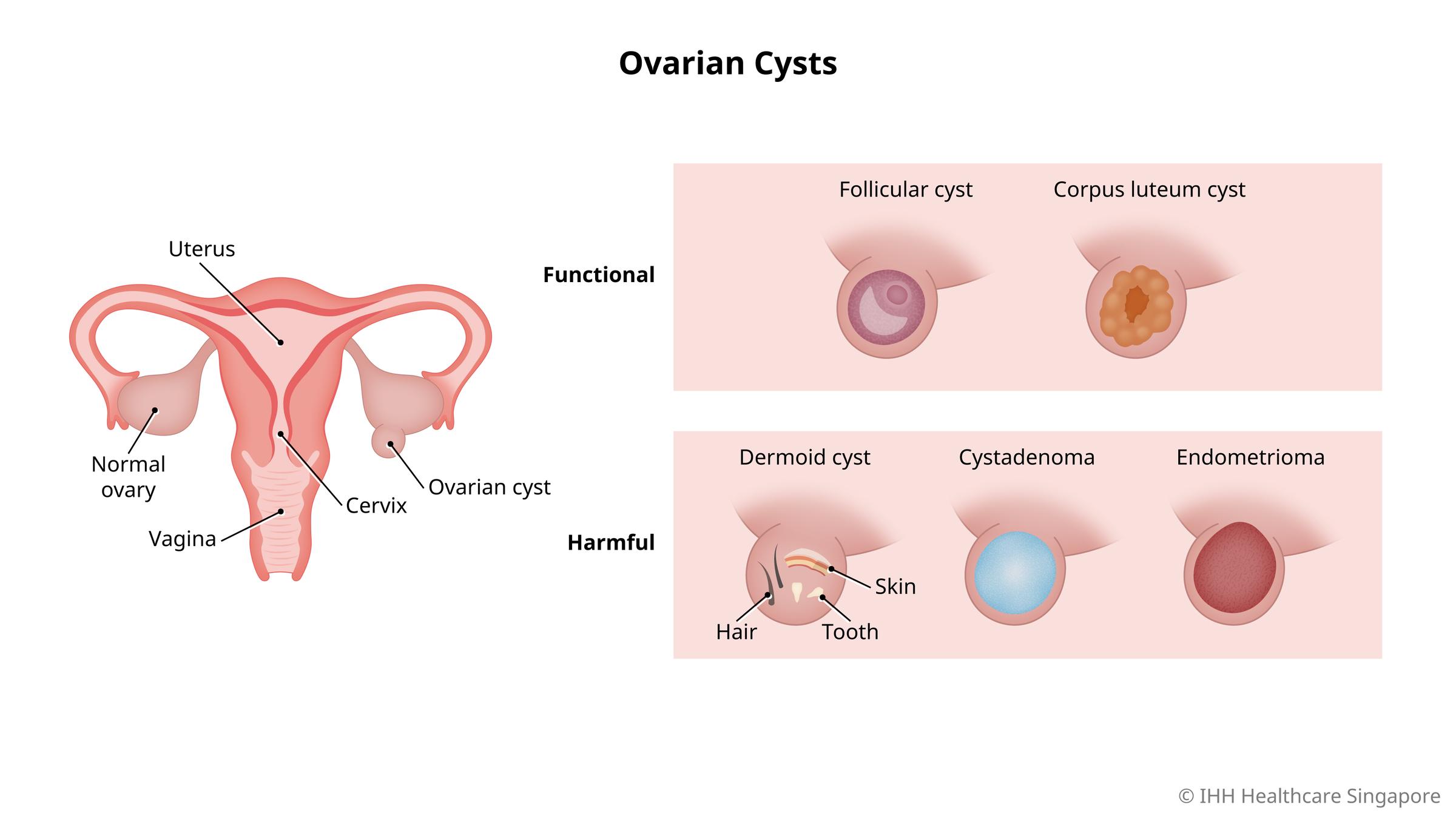 ovarian cyst pain location