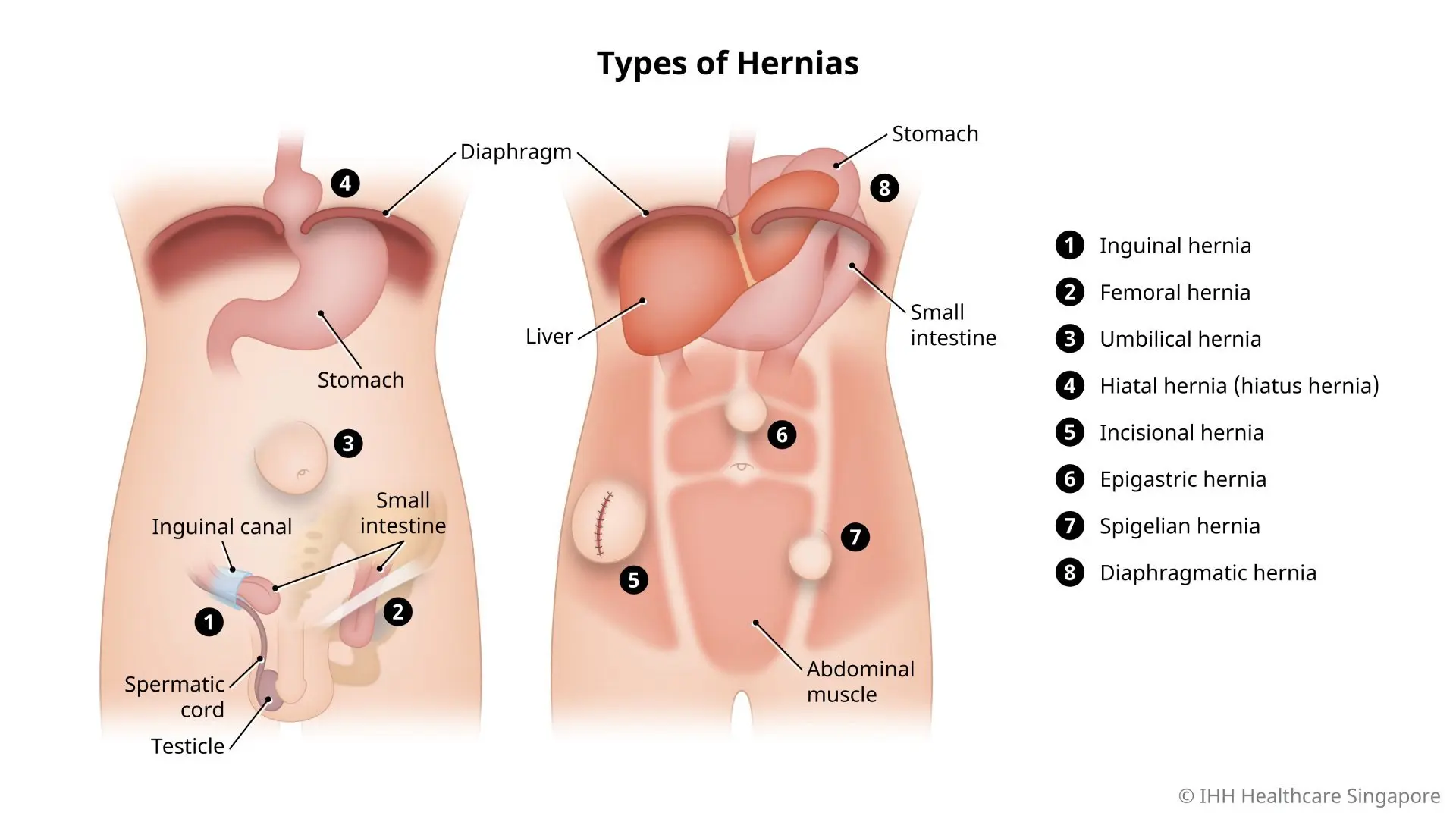 Illustration of types of hernias, like inguinal, femoral, umbilical, hiatal, incisional, epigastric, Spigelian, diaphragmatic