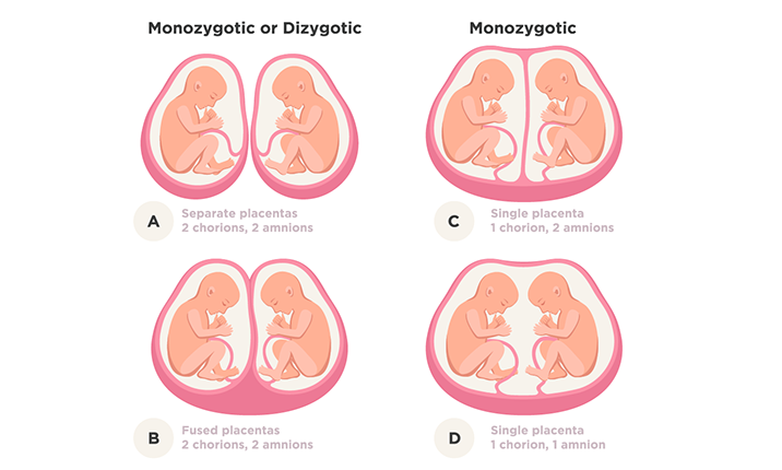 Types of twins