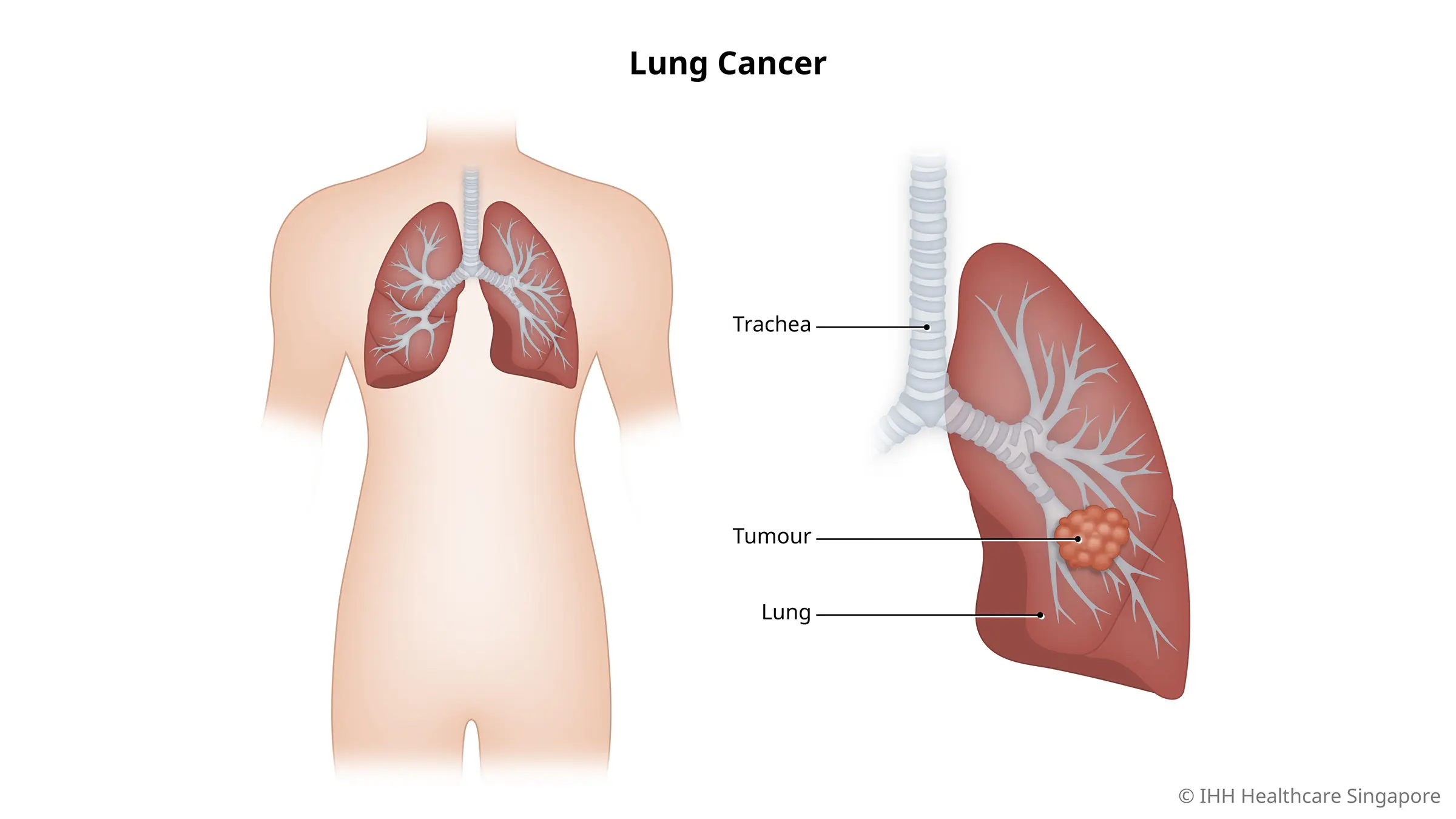Ignoring Lung Cancer Health: Unveiling the Consequences