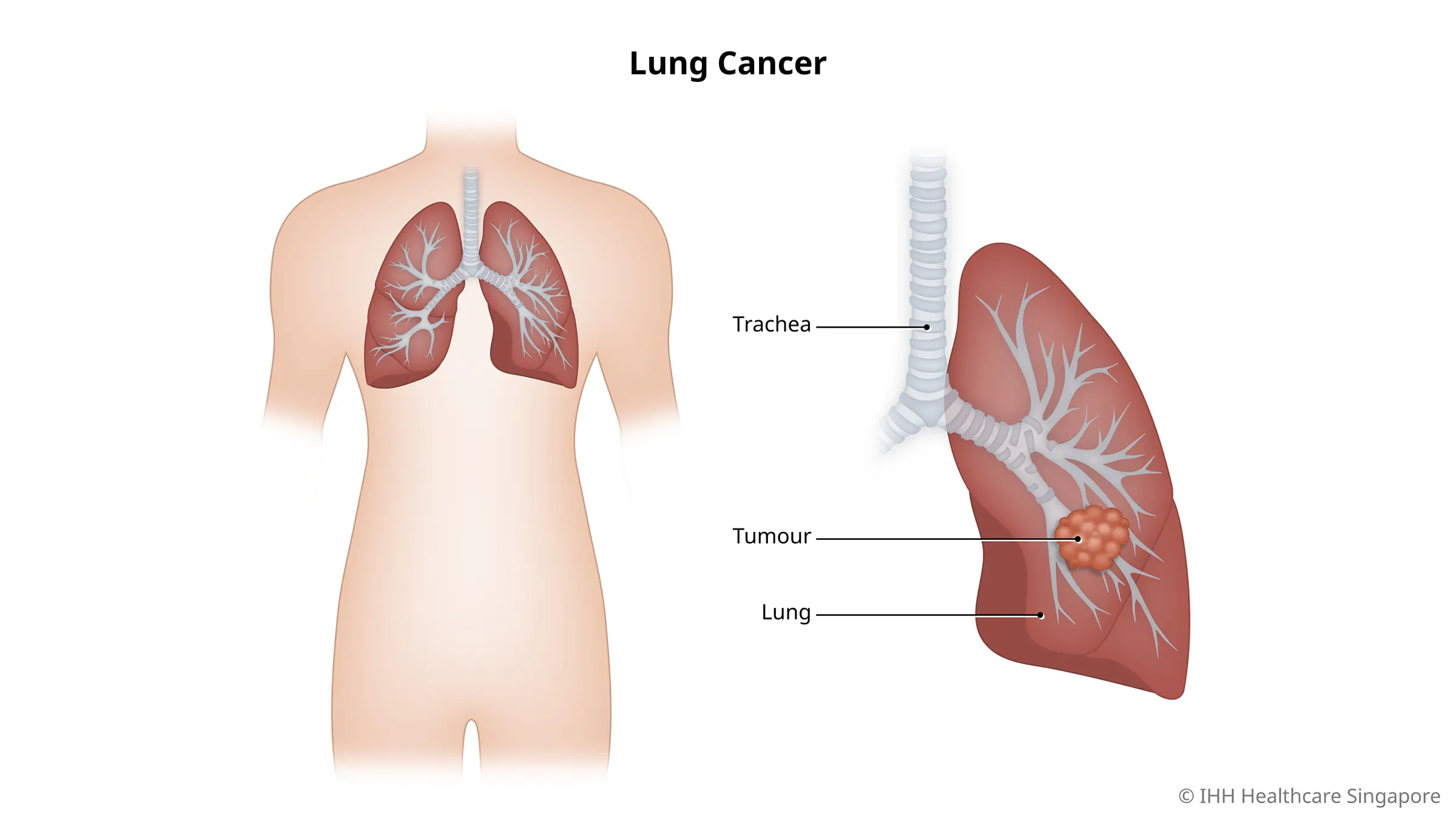 Lung Cancer in Older Adults: Treatment and Prognosis