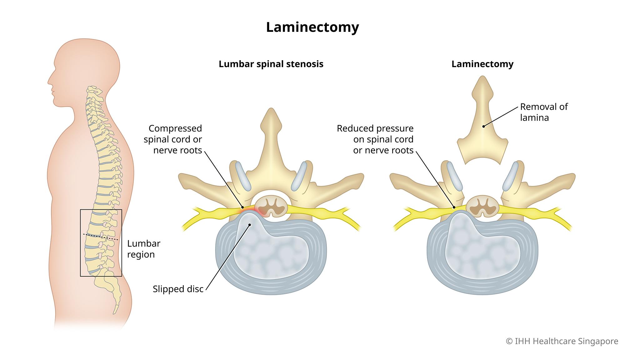 Decompression laminectomy reduces the pressure on the spinal cord or spinal nerve roots caused by spinal stenosis.