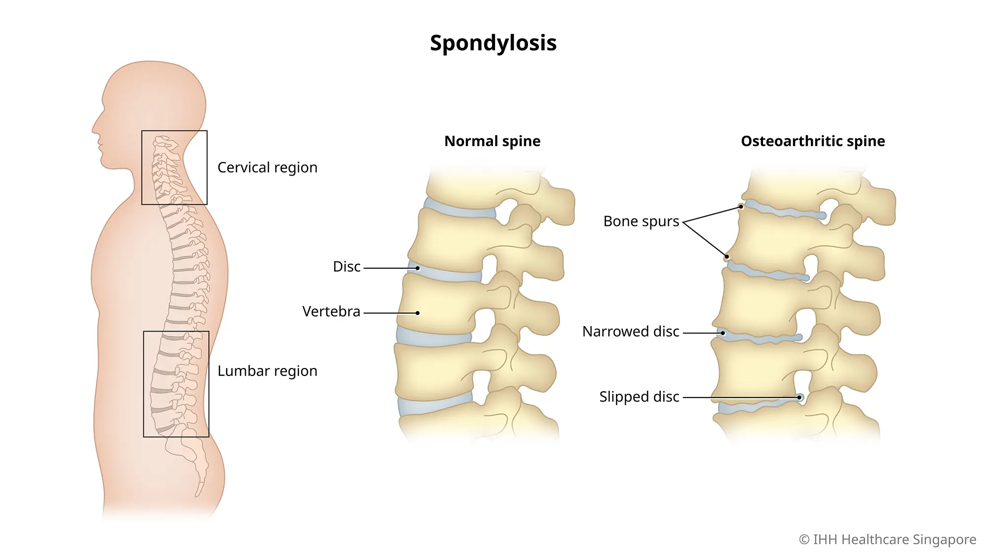 Thoracic Spondylosis: Causes, Symptoms & Treatment