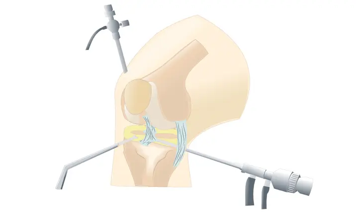 Apa itu artroskopi pemeliharaan lutut?